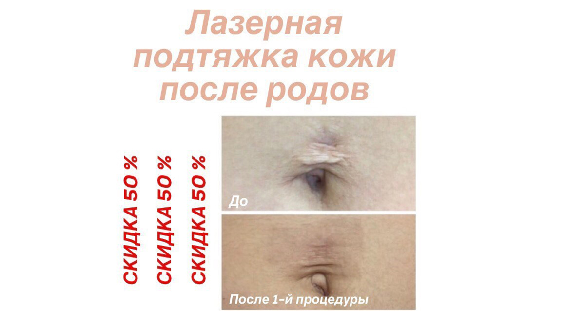 Методы для подтяжки кожи на животе Методы для подтяжки кожи на животе
